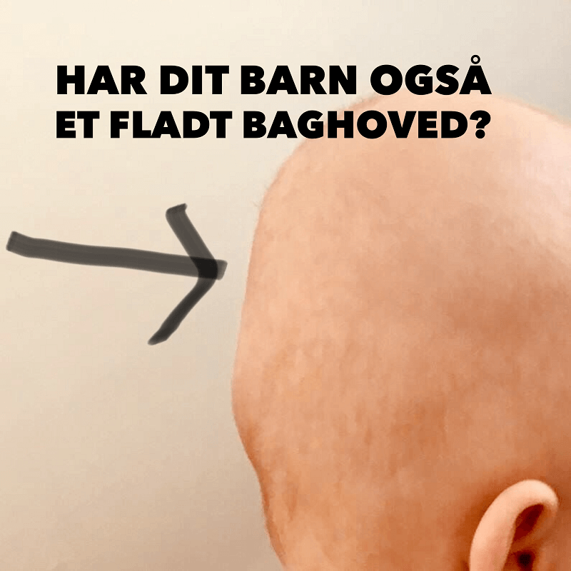 Fladt baghoved hos baby behandles med biodynamisk kranio-sakral terapi